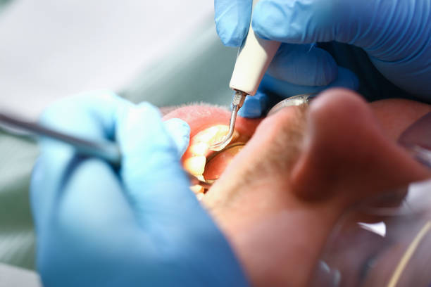 Best Emergency Tooth Extraction in Martinez, GA